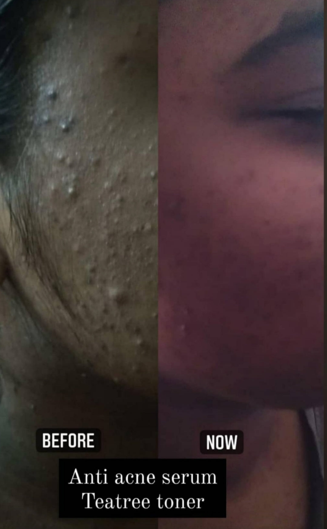 Anti Acne Serum